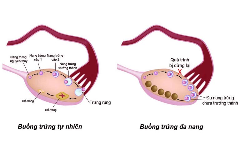 Khám buồng trứng đa nang