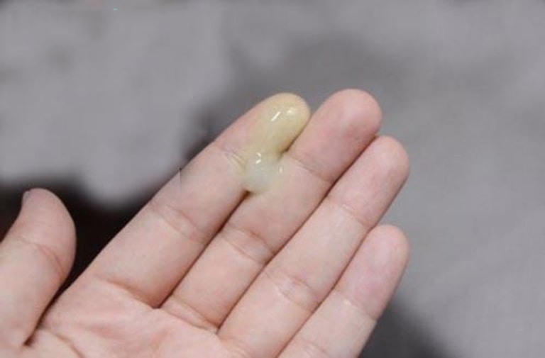 Khí hư màu vàng đặc dính