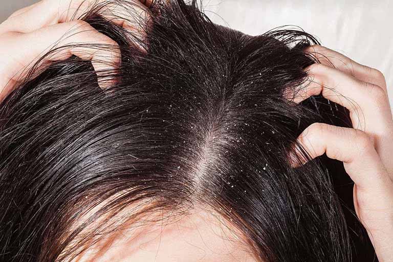 Hạn chê dùng tay cào gãi lên da đầu làm gia tăng nguy cơ bị nhiễm trùng