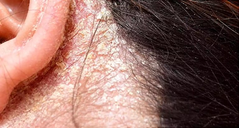 Triệu chứng nấm ở da đầu