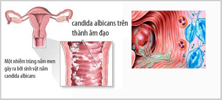 Nấm candida là chủng nấm phát triển mạnh ở âm đạo