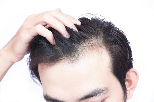 Nguyên nhân rụng tóc ở nam giới là gì?