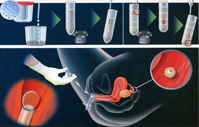 Thụ tinh nhân tạo là cách bơm trực tiếp tinh trùng vào buồng tử cung
