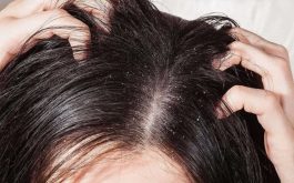 Các loại thuốc đặc trị nấm da đầu
