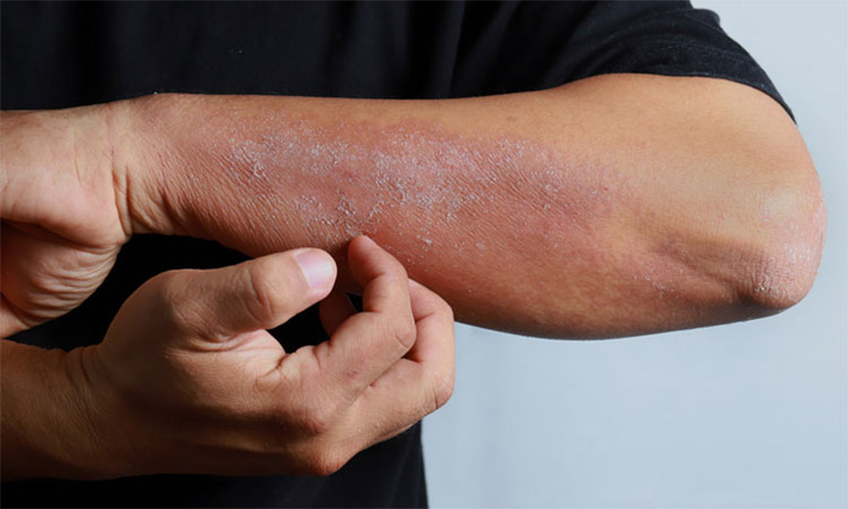 Tuyệt đối không nên gãi quá mạnh nên vùng da bị tổn thương để tránh tình trạng lây lan sang các vùng da lành khác
