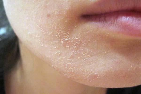 Bệnh viêm da tiết bã có lây không