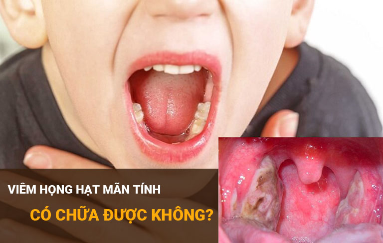 Viêm họng hạt mãn tính có chữa được không