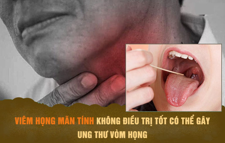 Viêm họng mãn tính có thể không chữa trị tốt dễ gây biến chứng