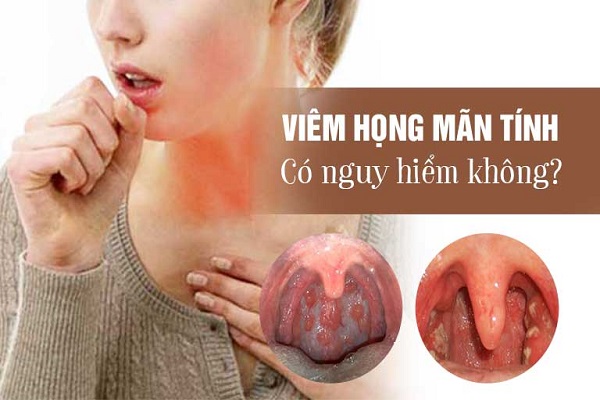 Viêm họng mãn tính có nguy hiểm không