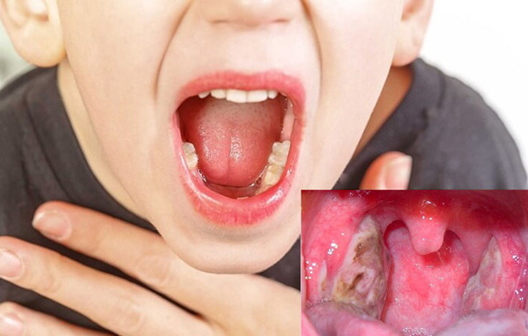 Bệnh viêm họng mủ ở trẻ em