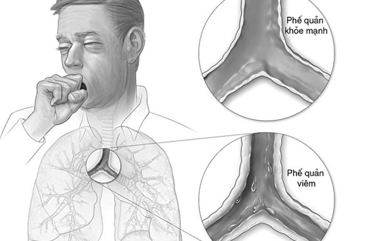 Viêm phế quản cấp làm tăng tiết dịch trong ống phế quản