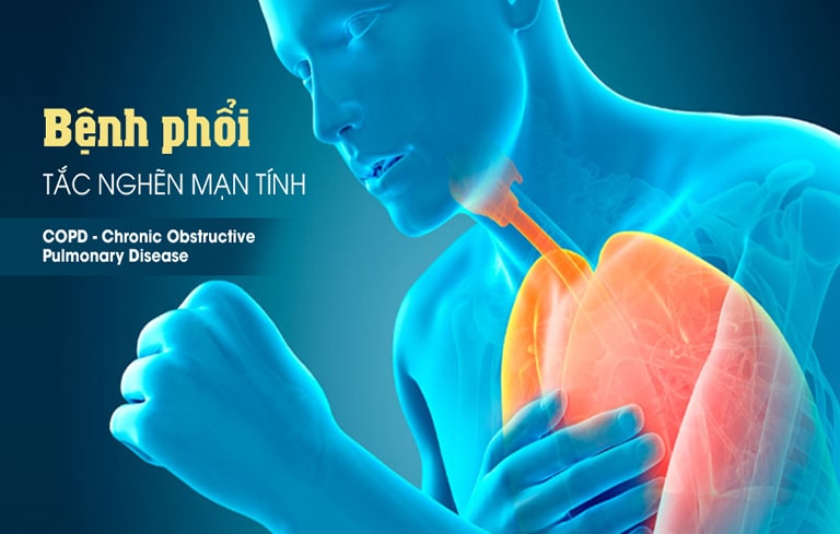 COPD hay bệnh phổi tắc nghẽn mãn tính là một biến chứng nguy hiểm của bệnh viêm phế quản.