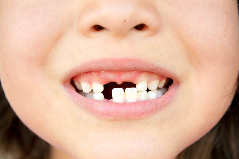 Mức độ nguy hiểm của bệnh áp xe chân răng ở trẻ