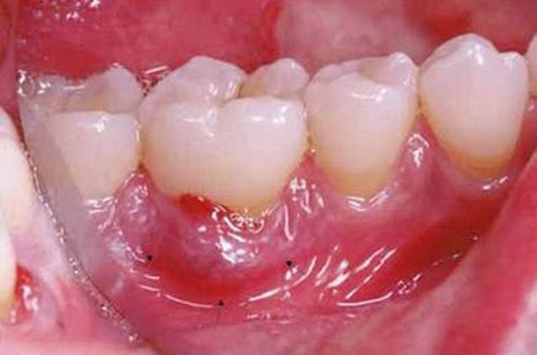 Bệnh áp xe răng không thể tự khỏi