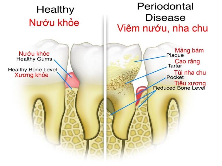 Răng và nướu của người bình thường với người bị viêm nha chu.