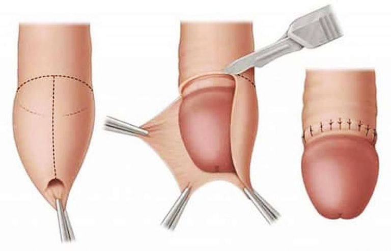 Phương án khắc phục hiệu quả nhất dành cho nam giới bị bao quy đầu dài là phương pháp cắt bao quy đầu, loại bỏ phần da thừa