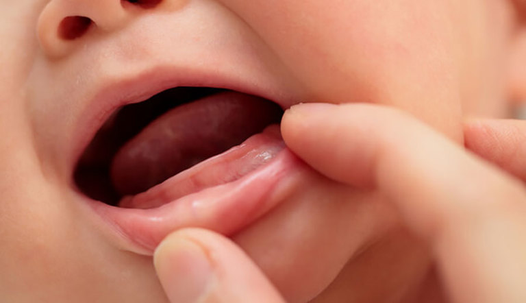 Trẻ bị viêm lợi, nhiệt miệng đôi khi là dấu hiệu của bệnh lý.