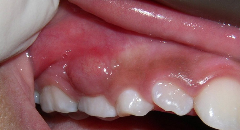 Bệnh áp xe răng có nguy hiểm không?