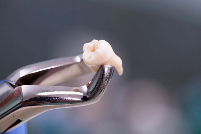 Nhổ răng là biện pháp cuối cùng trong việc điều trị bệnh áp xe răng