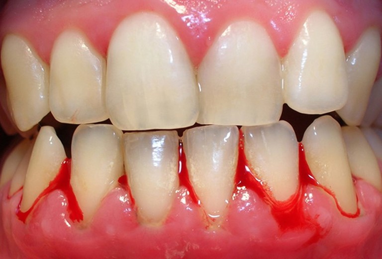Bệnh lý gây chảy máu chân răng thường đi kèm với biểu hiện tụt lợi.