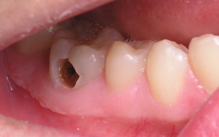 Sâu răng là một trong những bệnh lý thường gặp khiến răng bị ê buốt kéo dài.