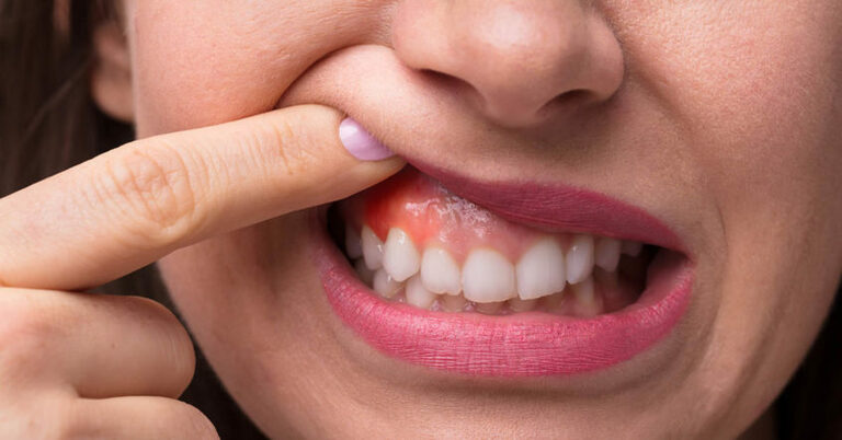 Teo nướu răng do bệnh nha chu có thể gây nguy hiểm nếu không điều trị kịp thời. Biểu hiện ban đầu của bệnh là tình trạng sưng đỏ và chảy máu nướu.