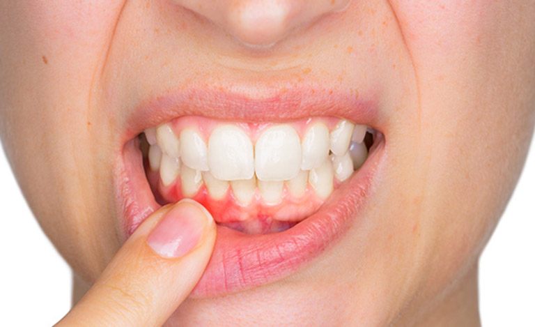 Viêm nha chu là bệnh răng miệng thường gặp khiến người bệnh cảm thấy đau nhức khó chịu