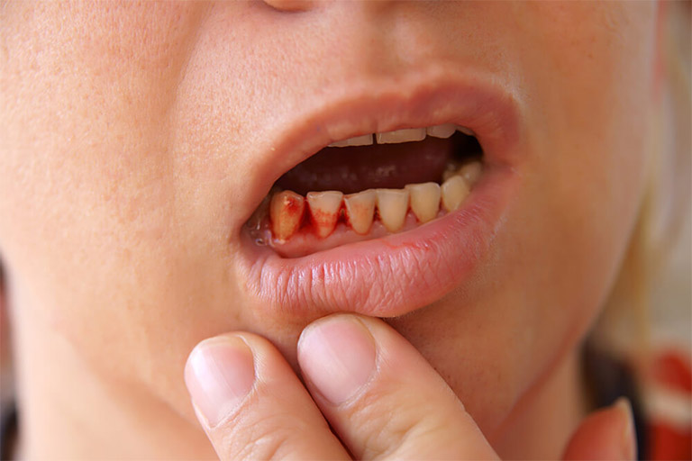 Chảy máu chân răng là một trong những trường hợp biến chứng nhẹ của bệnh viêm nha chu