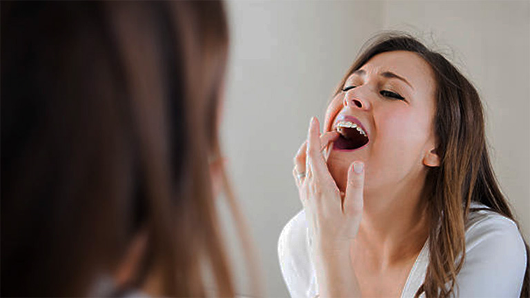 Răng lung lay hoặc mất răng là dấu hiệu của bệnh viêm nha chu đang tiến triển ở giai đoạn nặng