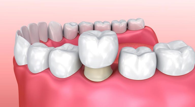 Vệ sinh chân răng, chữa nhiễm trùng tủy rồi bọc răng sứ là giải pháp ưu tiên hàng đầu trong những trường hợp răng hàm bị sâu chỉ còn chân.