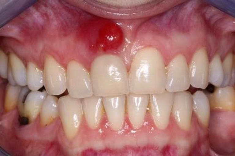 5 cách chữa viêm chân răng có mủ tại nhà từ các thảo dược