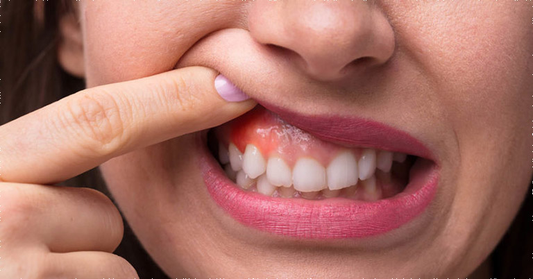 Người bệnh luôn mắc phải những cơn đau khó chịu vùng răng nướu khi bị viêm nha chu