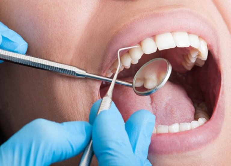Làm sạch sâu là giải pháp ưu tiên hàng đầu trong những trường hợp teo nướu răng ở dạng nhẹ.