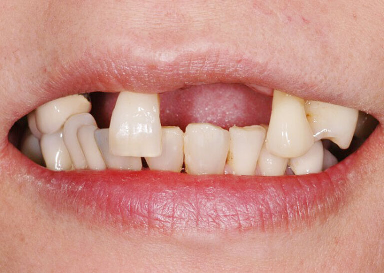 Ê buốt răng kéo dài trong một số trường hợp có thể dẫn đến rụng răng.