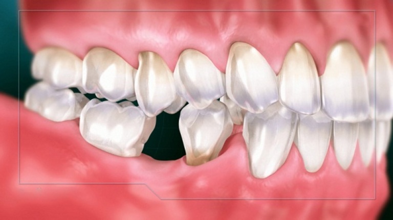Đau răng hàm trong cùng chữa sai cách hoặc quá trễ sẽ mất răng vĩnh viễn. Đồng thời, tủy và xương hàm cũng sẽ bị ảnh hưởng.