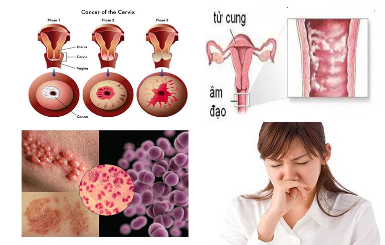 Kinh nguyệt có mùi hôi do vi khuẩn viêm nhiễm, khuẩn bệnh lây qua đường tình dục gây ra