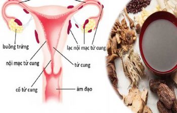 Sử dụng Đông y chữa lạc nội mạc tử cung rất an toàn cho sức khỏe và mang đến hiệu quả lâu dài, không tác dụng phụ