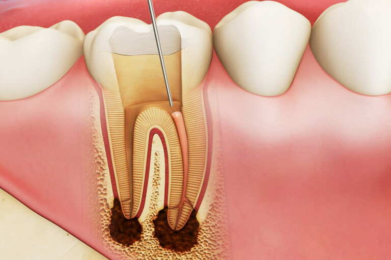Viêm tủy răng không thể tự phục hồi. Giải pháp điều trị phổ biến là lấy tủy đã bị viêm nhiễm ra ngoài rồi hàn kín tủy.