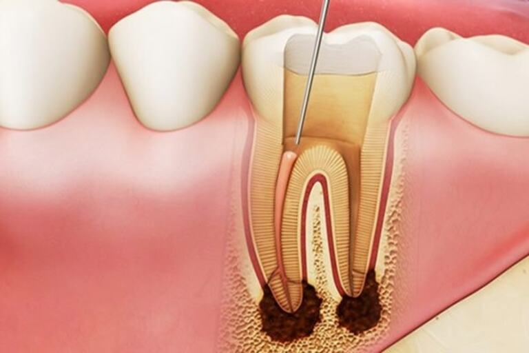 Lấy tủy giúp răng không còn ê buốt nhưng thường đi kèm nhiều hệ lụy nếu không chú ý cách chăm sóc miệng sau điều trị.