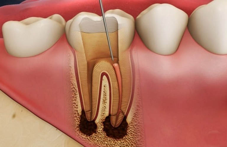 Lấy tủy răng có đau không? 