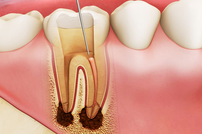 Tủy răng còn sót lại bên trong là nguyên nhân dẫn đến đau nhức sau khi lấy tủy khá phổ biến