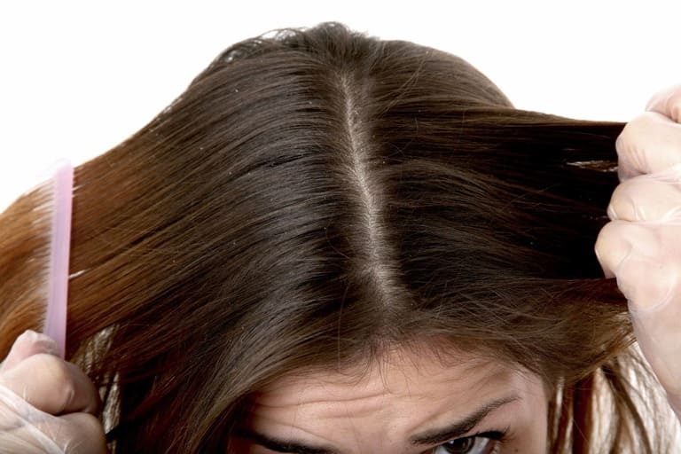 Nấm da đầu nặng ảnh hưởng đến sức khỏe như thế nào?