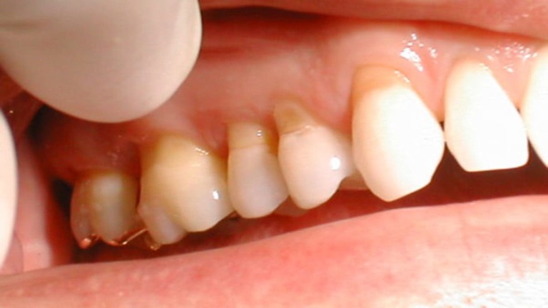 Nhổ răng bị áp xe