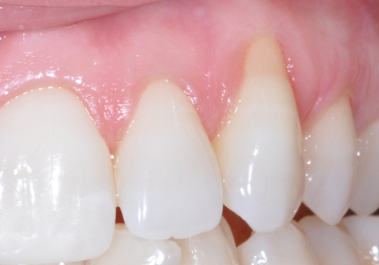 Teo nướu răng do nhiều nguyên nhân. Trong đó tác động từ bệnh lý và sinh hoạt không đúng cách chiếm đa số các trường hợp bị tình trạng này.