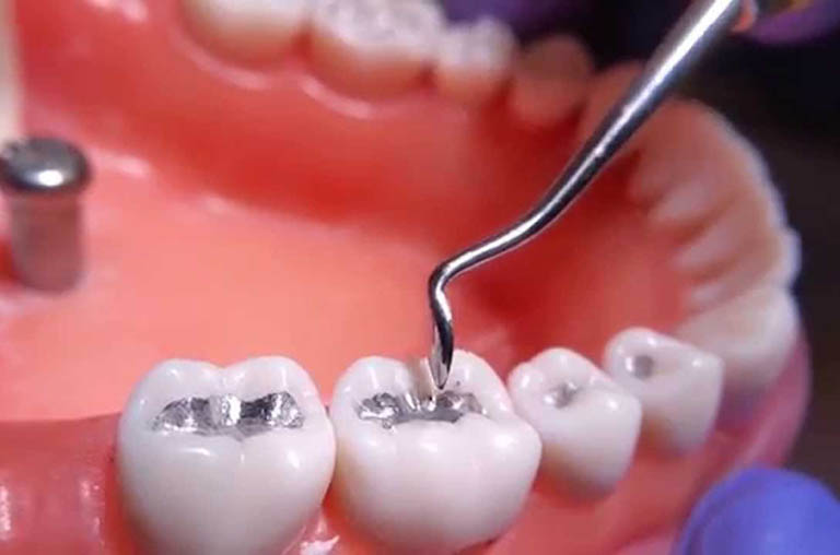 Điều trị răng cấm bị sâu bằng phương pháp trám Composite