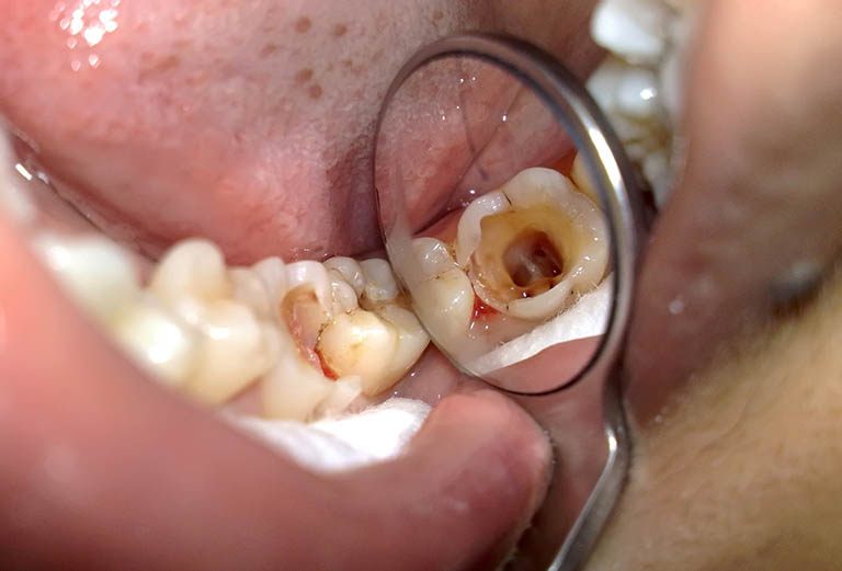 Răng cấm bị sâu: Đâu là phương pháp phục hồi răng hiệu quả