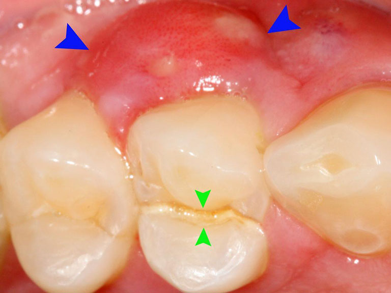 Răng sâu bị ê buốt