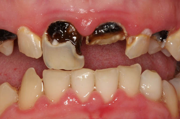 Nguyên nhân khiến răng sâu bị vỡ, bể, mẻ