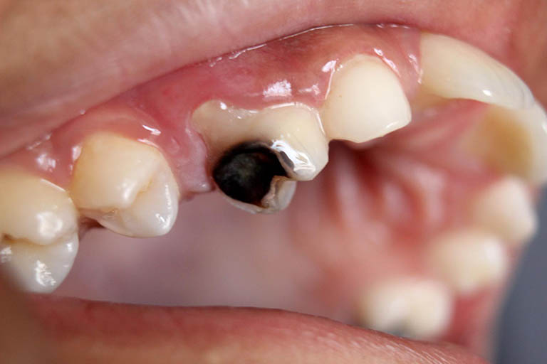 Những nguy hại khi răng sâu bị vỡ, bể, mẻ