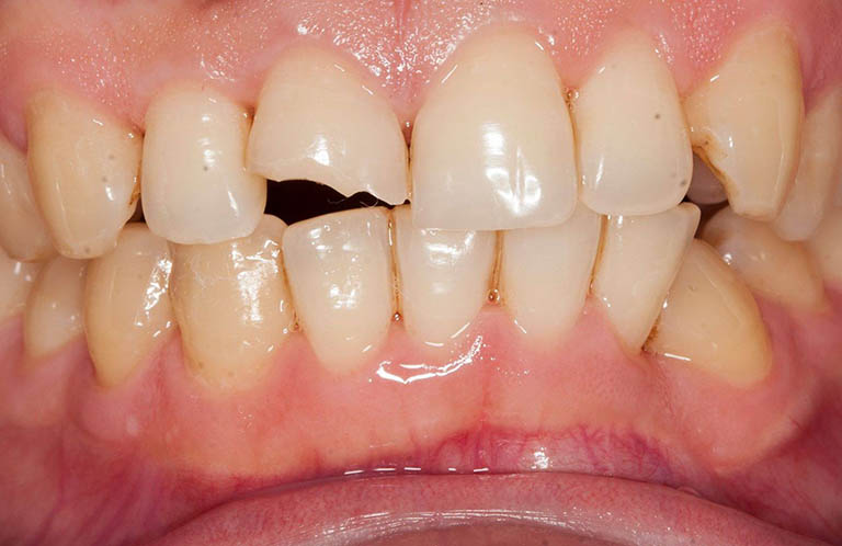 Răng sâu bị vỡ, bể, mẻ nên làm gì? Lời khuyên từ chuyên gia